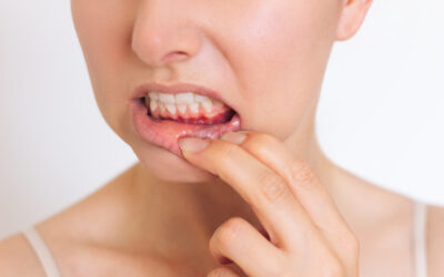 Diferencias entre gingivitis y periodontitis: cómo identificarlas y tratarlas