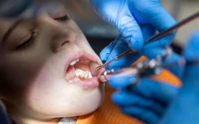 Mitos y realidades sobre las caries dentales: Desmontando creencias comunes