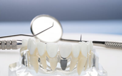 Implantes dentales vs. prótesis removibles: ¿Cuál es mejor para ti?