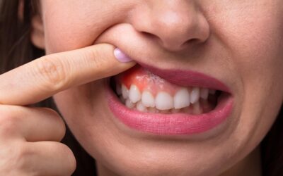 ¿Qué es la periodontitis y cómo se trata? Guía completa