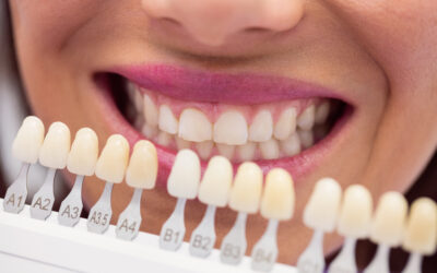 Blanqueamiento dental antes de un evento: ¿Cuándo hacerlo?