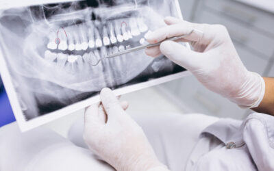 ¿Empaste o Endodoncia? Cómo saber si tu diente aún se puede salvar